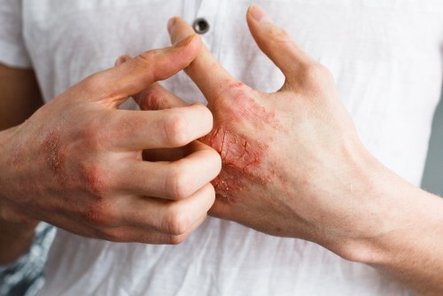 juckende Haut eczema