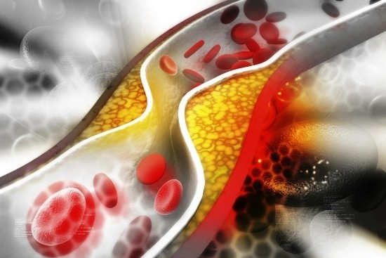 Cholesterin senken auf natürliche Weise verstopfte arterien herzanfall