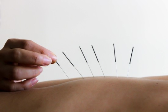 was tun gegen nackenschmerzen akupunktur gesund