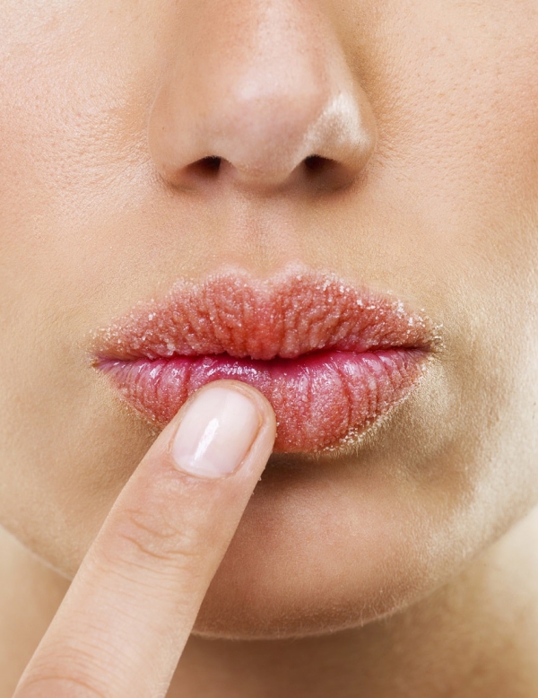 Spröde Lippen – Pflegetipps aus der Naturaptheke unschöne spröde lippen wieder heilen