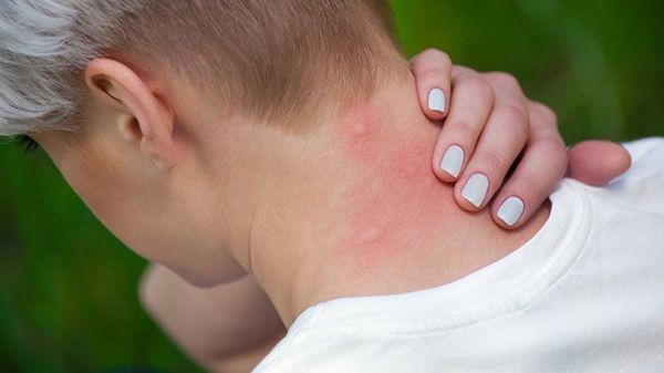 Mückenstiche behandeln Tendenzen in der Gesundheit